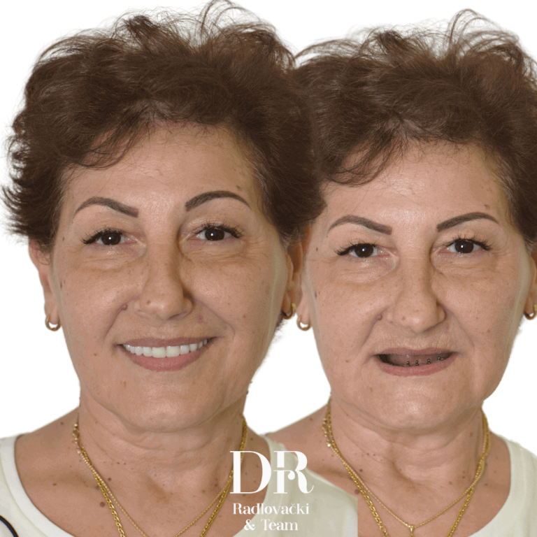 Totalna bezubost - pre i posle