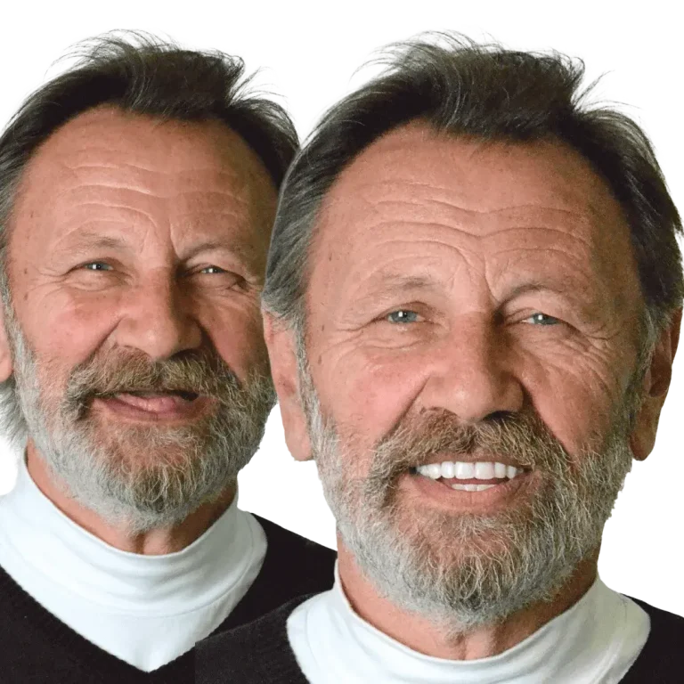 pre i posle rad stomatološke ordinacije radlovački & tema koji pokazuje rezultate i osmeh pacijenta nakon sto je ugradio proteze na drikerima