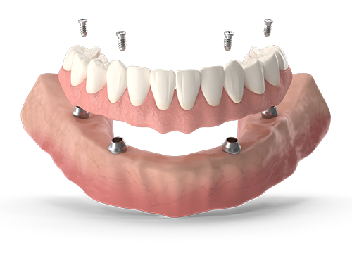 All on 4 zubni implanti - ikona