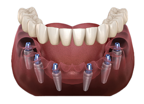 All on 6 zubni implanti - ikona