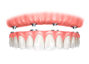 Proteze na implantima