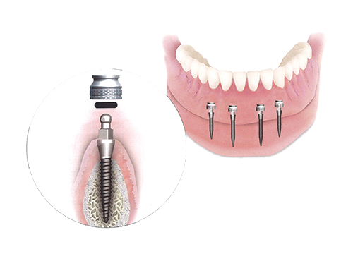 Mini implant - ilustracija ugradnje