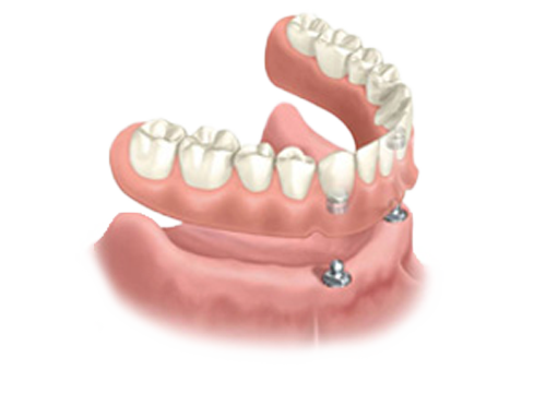 Proteza na klik - overdenture sistem