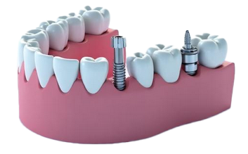 Zubni implantati - ilustracija ugradnje