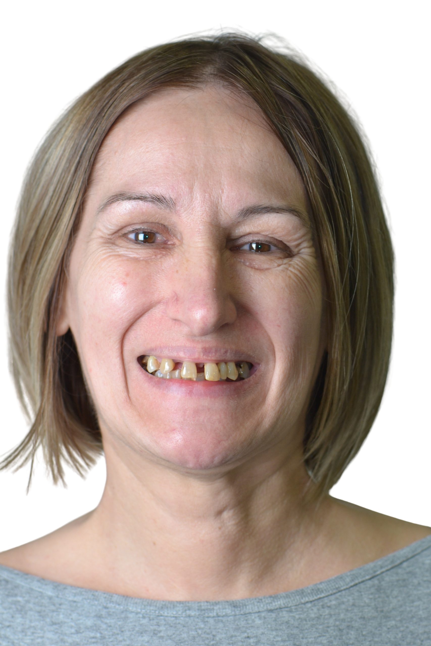 Before All-on-6 dental implants – Dr Radlovački Belgrade