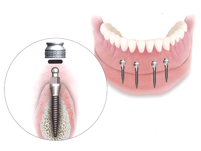 Mini implantati u donjoj vilici sa kuglastim glavama — mehanizam proteze na mini implantima