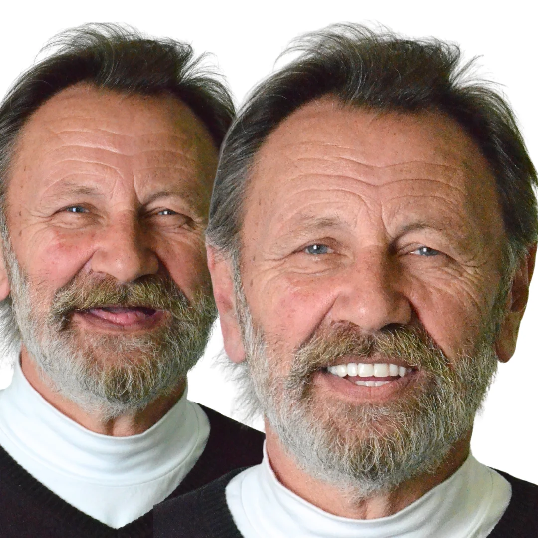 Proteza na klik — pre i posle, stvarni pacijent ordinacije Protetica