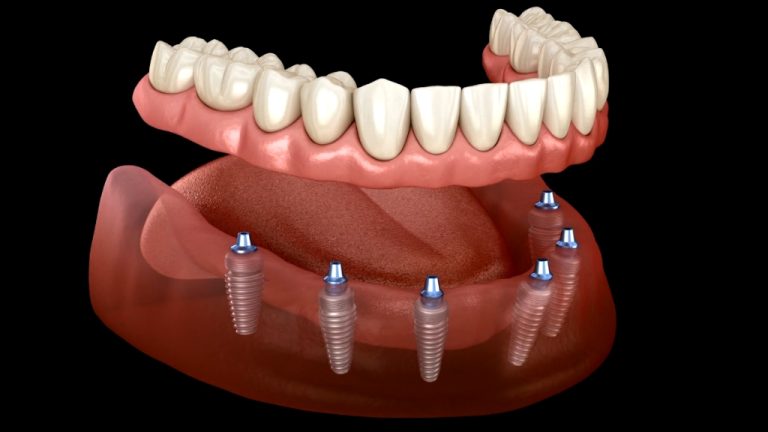 All-on-6 — šest implantata duž donje vilice
