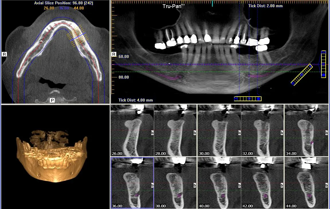 3D CBCT dijagnostika i planiranje implantata — centar Protetica