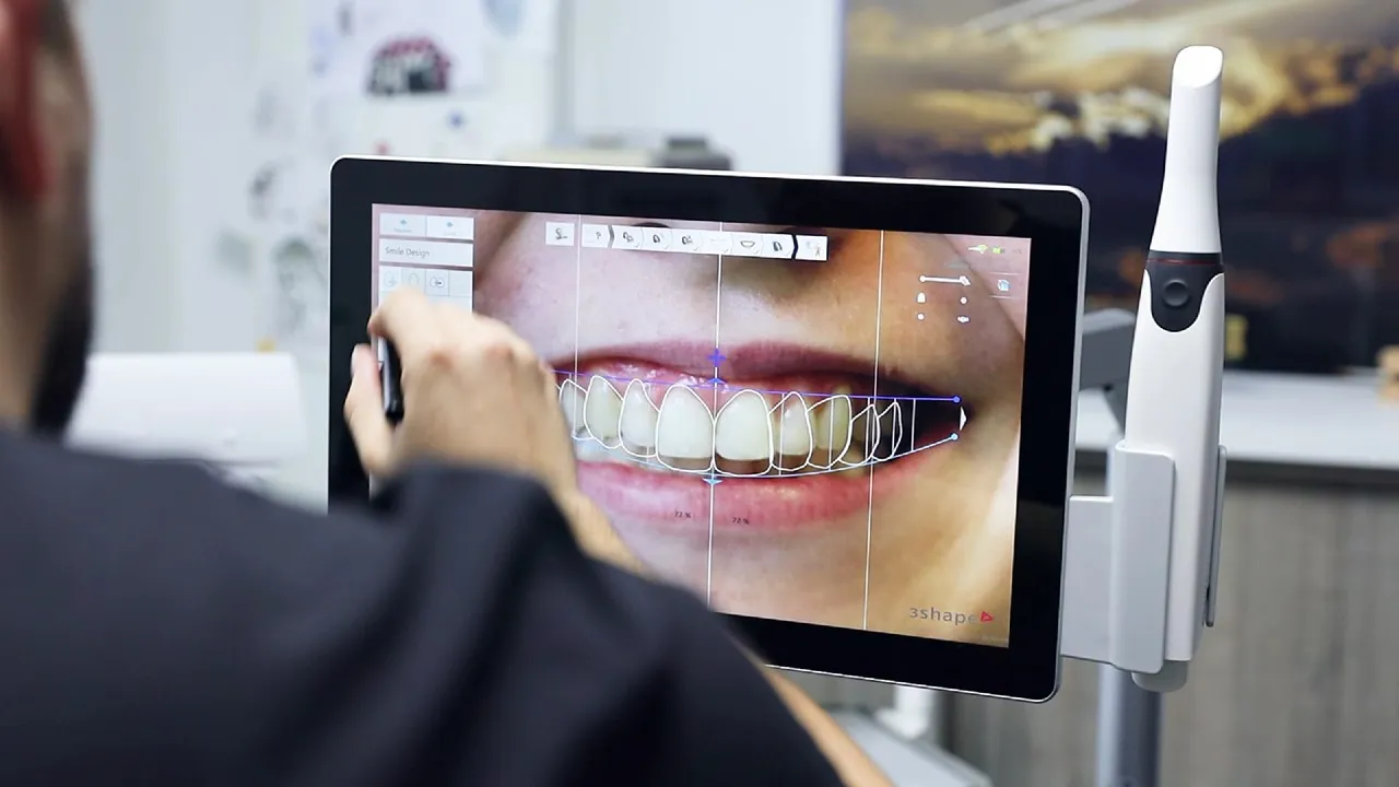 Digitalni dizajn osmeha u 3Shape softveru — planiranje prema licu pacijenta