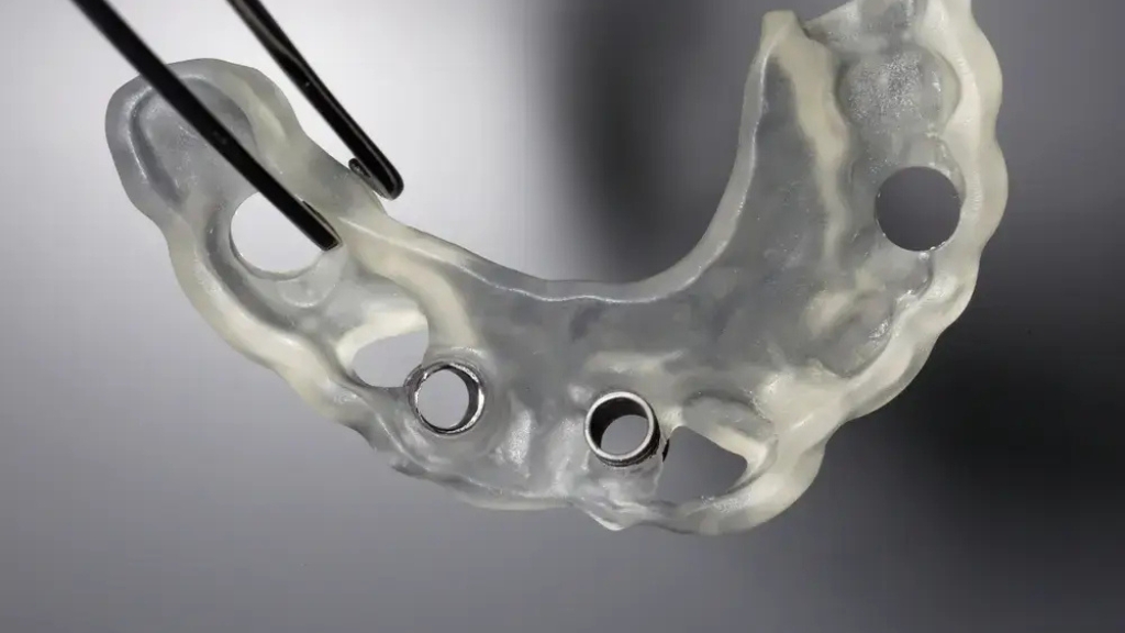 Hirurški vodič za digitalno vođenu ugradnju implantata