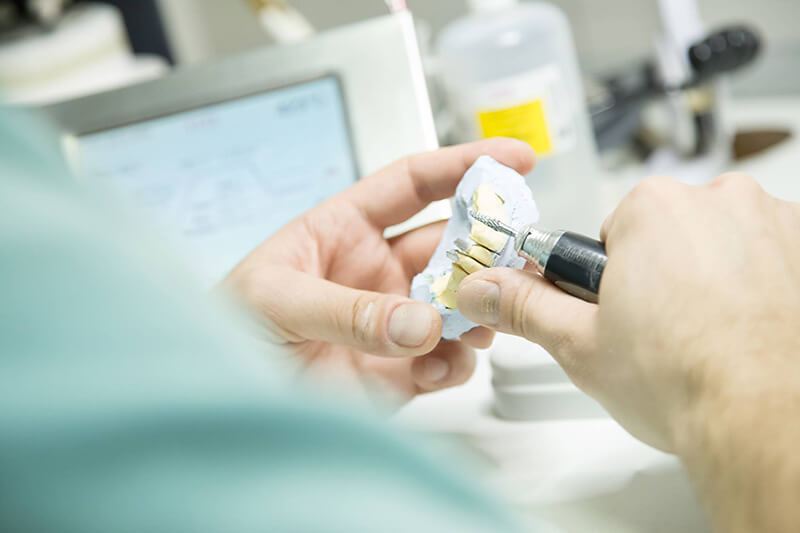 Izrada fiksnog mosta u digitalnoj zubnoj tehnici